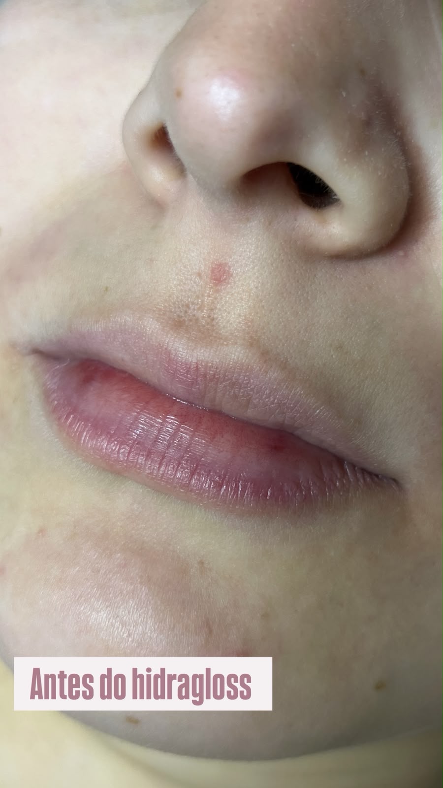 Resultado Microagulhamento Labial