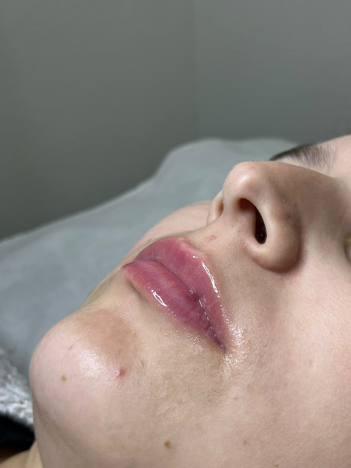 Resultado Microagulhamento Labial