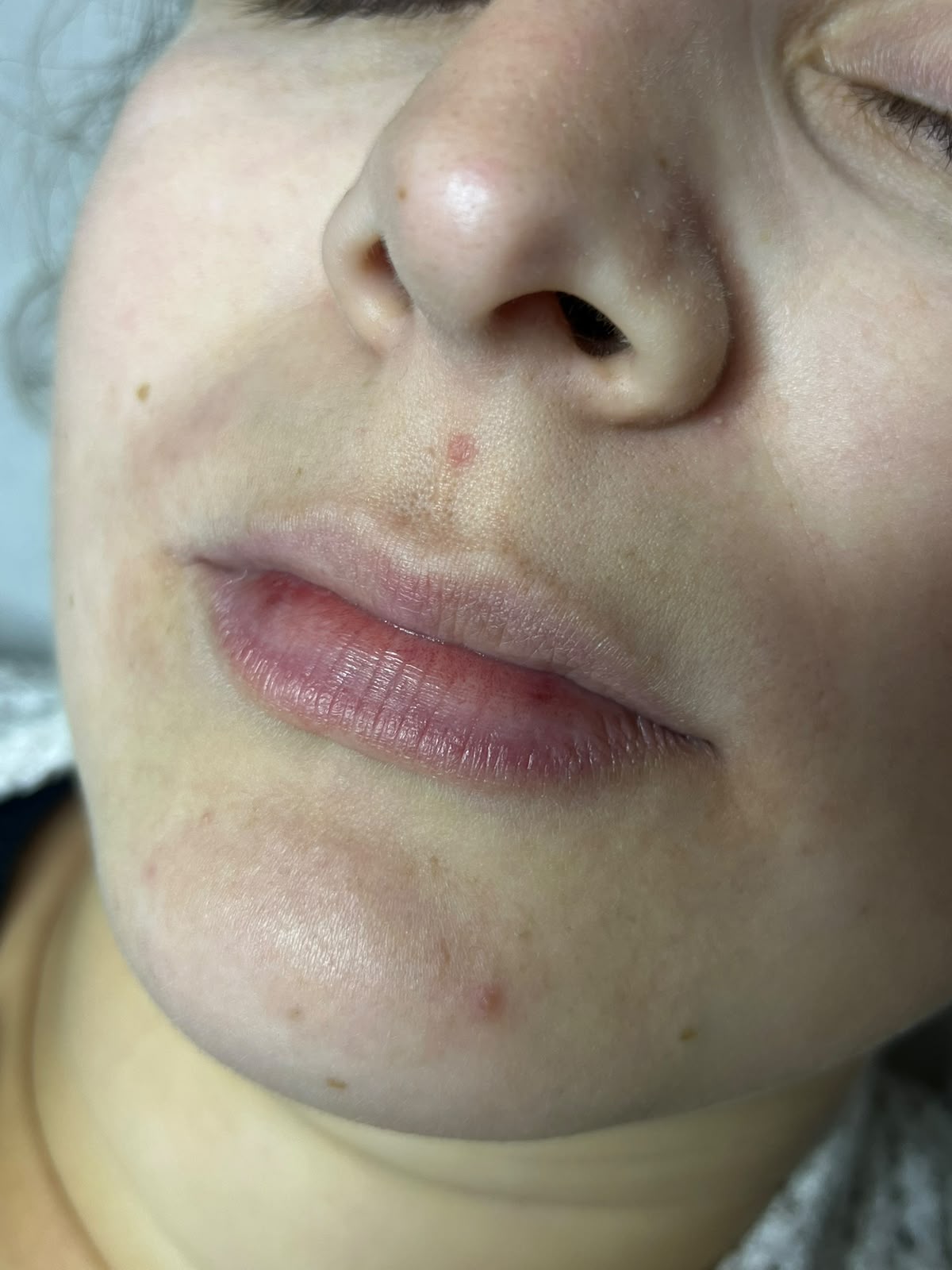 Resultado Microagulhamento Labial